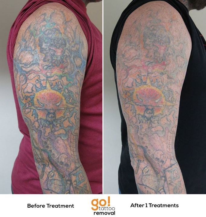Permanent tattoos can go against their title but not without intense  removal processes  The Central Trend