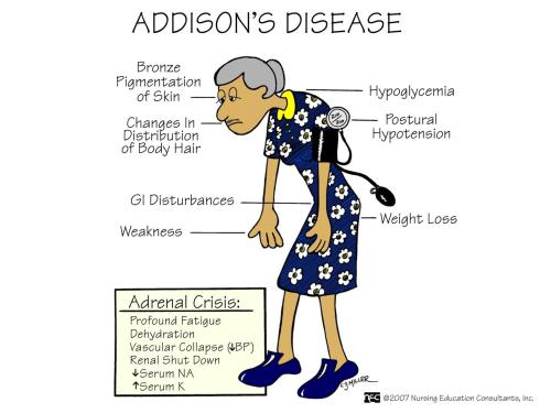 jewsee-medicalstudent: Addison’s Disease. Addison’s disease is a rare but known disorder