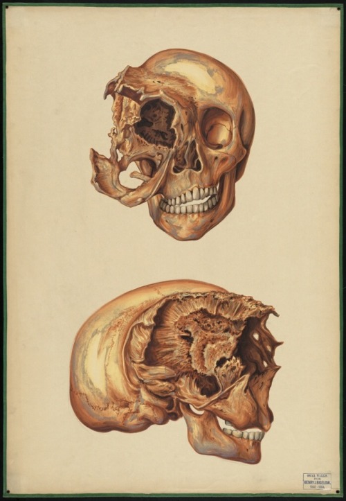 thefancywalrus: Watercolor paintings of diseased skulls by Henry Jacob Bigelow. Between 1849-1854.  
