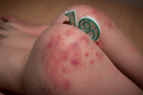 defiantly-yourss:  wtf-mcb-123:  defiantly-yourss:  Birthday cake.  (Thanks @vanerotica for lubing up the candles and not calling me crazy for proposing this idea)  What’s the red irritation on your sexy ass? Candle wax? Allergies?  Bruises from being