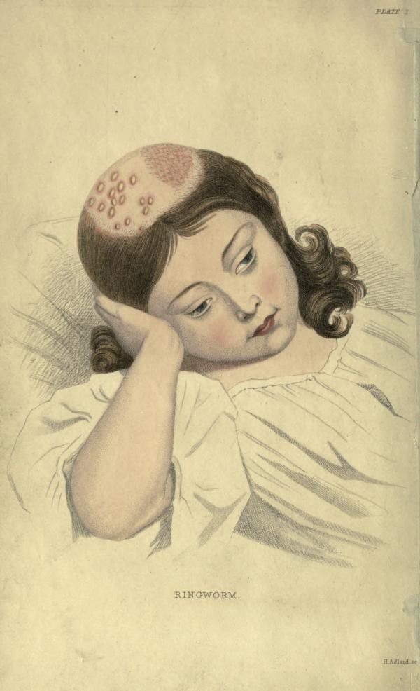 nemfrog: Frontispiece. Ringworm. The skin, in health and disease. 1849. 