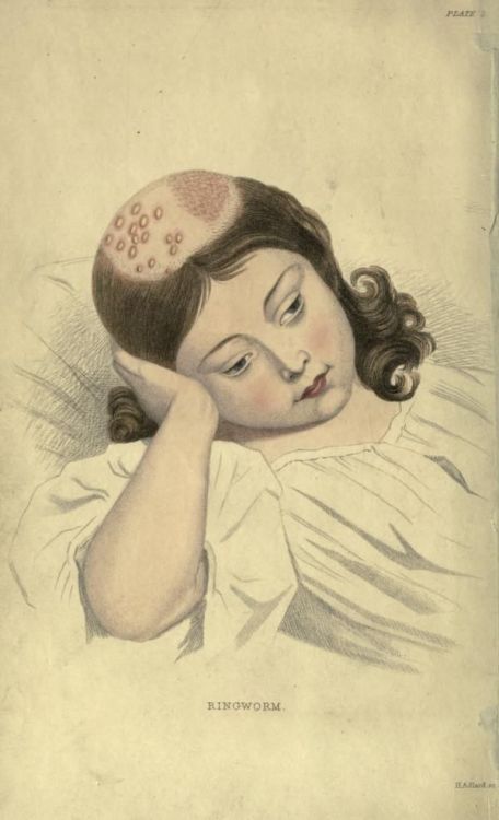 nemfrog: Frontispiece. Ringworm. The skin, in health and disease. 1849. 