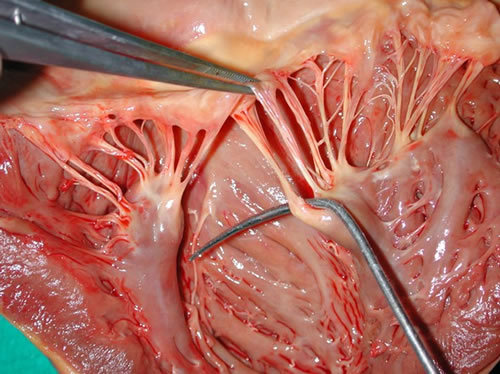  Anterior mitral valve leaftlet secondary (strut) chordae tendinae 