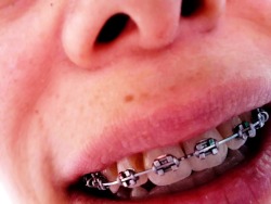   With My Braces And Pacifier (5 Pics)I Sometimes Wear My Braces. I’m Real Good