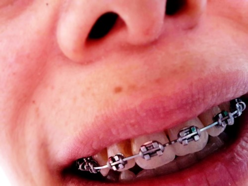   With my braces and pacifier (5 pics)I sometimes porn pictures