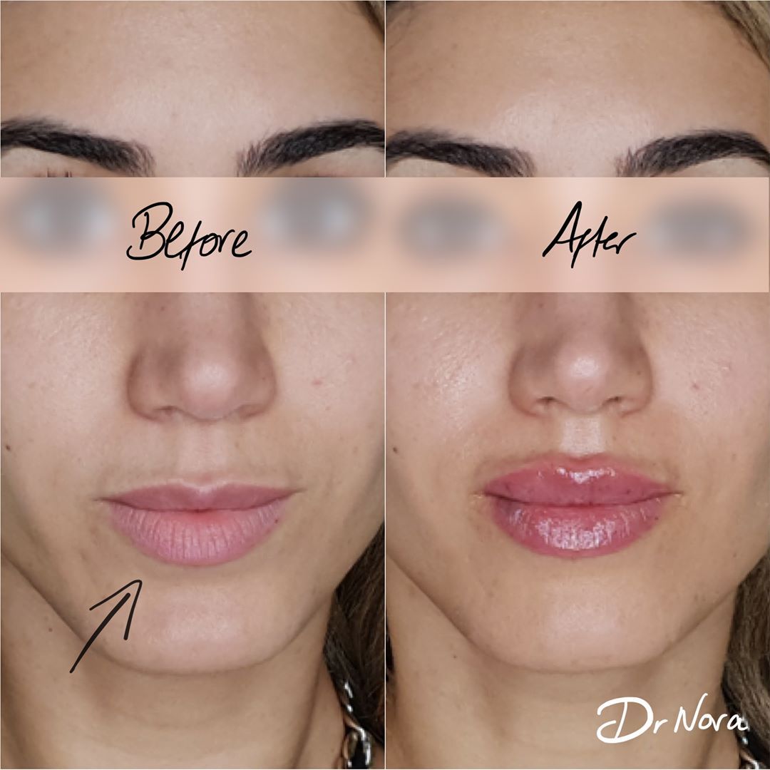 1ml lip filler 👄Treatment time is around 20 minutes and swelling and bruising is seen straight after settling at around 3-5 days with optimal results at 2 weeks.
If you’re interested in finding out more or to book, head over to drnora.com.
Take care...