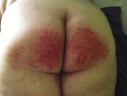 submissivefeminist:  Daddy spanked me raw