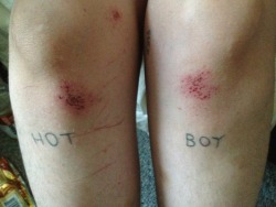 slugpunx:  the best thing about summer is having scraped knees B)  wounds are rarely pleasant