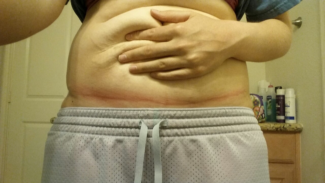 flabofsteel:  flabofsteel:  Let’s talk about excess skin and chaffing, okay? I’ve