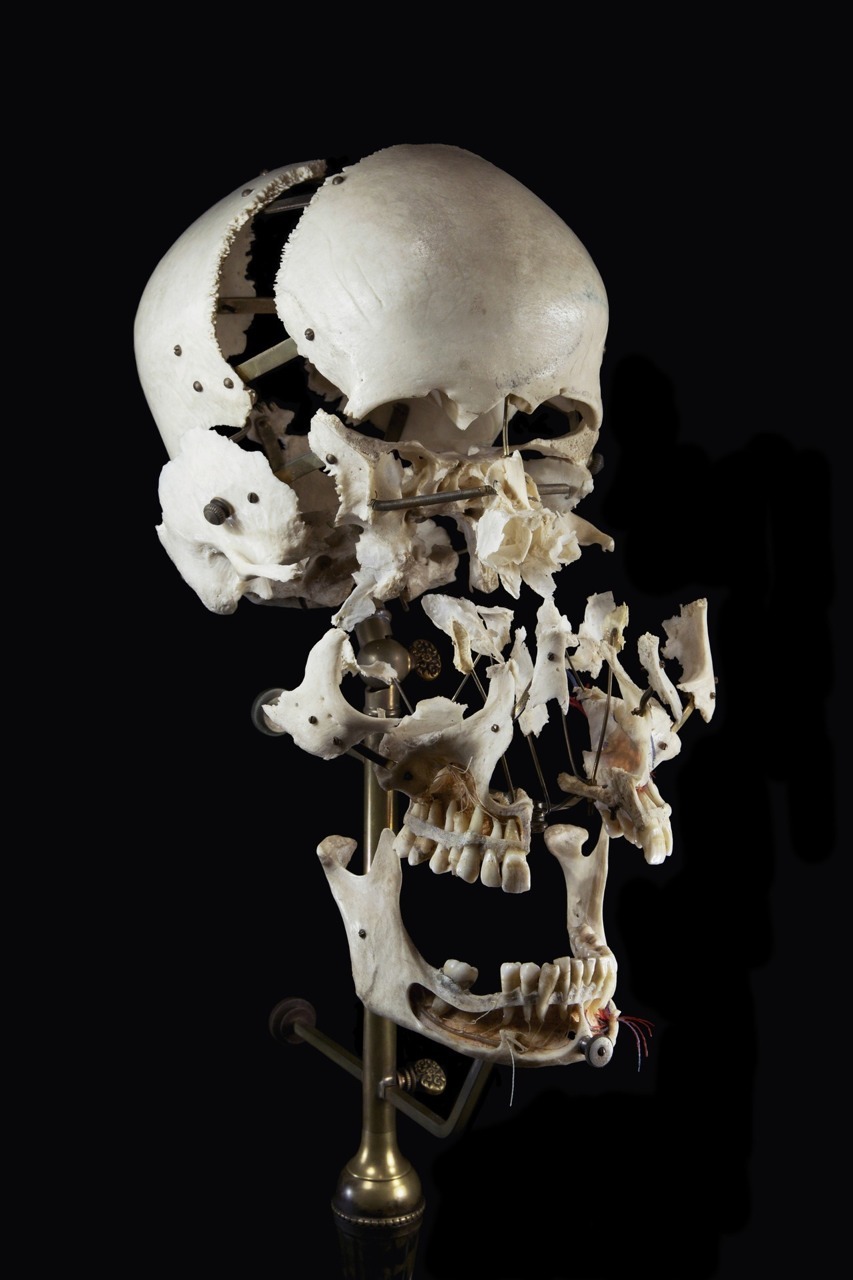 jack089:  Exploded and dissected skulls. Beauchene Skull - Mounted preparation of
