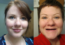 bogleech:  christmas-kuchen:  These photos were taken around one year apart.  One year. Can you imagine living your life without teeth?  https://www.gofundme.com/toothless-and-desperate  Have a brief example of what you’d experience: - Unable to eat