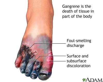 Tissue necrosis from im injection