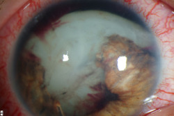 coma-kidd:  Traumatic cataract 