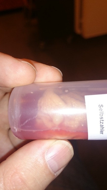 circumcisedperfection:  celticbear-getting-cut:  it is done. My husband is circumcised. I’m waiting for him to wake up.  This is the foreskin in a tube. You can see the bump  Thank fuck it’s cut