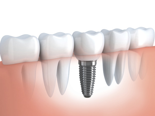 Dentures that look natural teeth