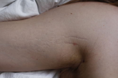 ginocchia:  My boyfriend’s stretch marks, one of the most beautiful things I’ve ever seen.