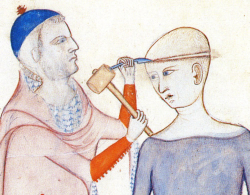 Surgeon Conducting a Trephination, from Anothomia Designata per Figures (1345) - Guido da Vigevano (