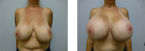 Extremely Huge Boobs