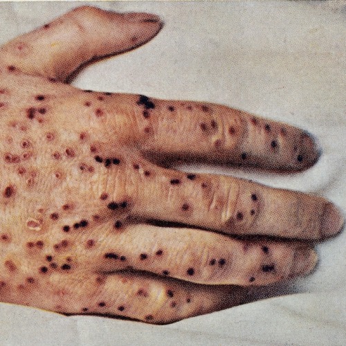 lepromatosis:  “Obsolescent variolous lesions. On the hand the brown or black crusts were still adhe