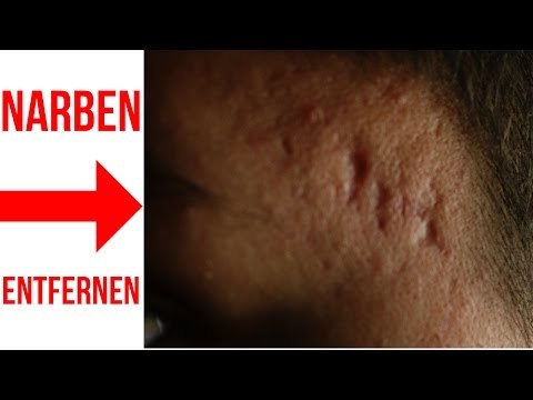 Am bauch pflegen narbe Narbenbehandlung nach