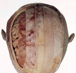orqueen:  (from right to left) Scalp, Periosteum, Bone, Dura Mater Arachnoid Mater, Pia Mater, Brain. 