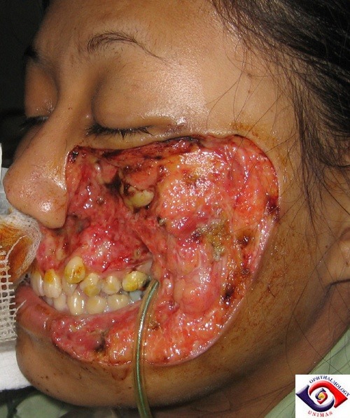 A 23 year-old woman developed a left facial cellulitis which progressed relentlessly with necrosis. Debridement was performed on several occasions to halt the spread of the necrosis.Examination revealed poor ocular movement, an urgent CT scan revealed