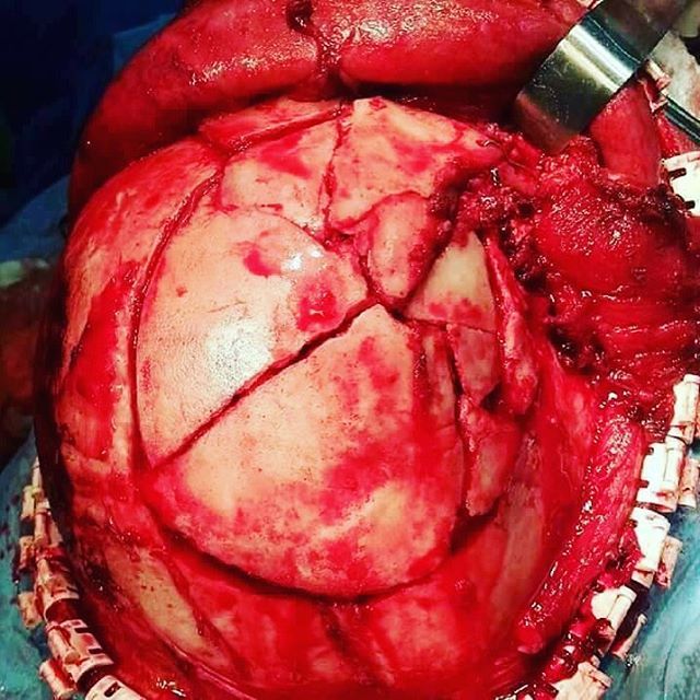 doctordconline:Compound Depressed Skull Fracture ….  #RTA #fracture #skull #neurosurgery