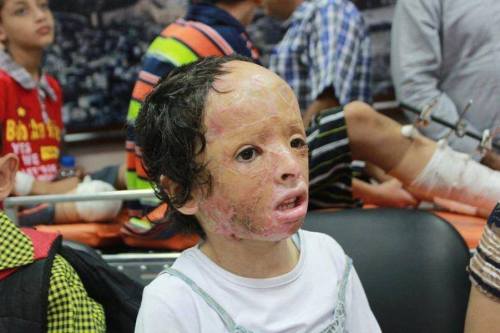 famee:  merelypassion:  golden-spoon:  beinpalestine:  This is what ‪Israel‬ inflicts on children in ‪Gaza‬. But it doesn’t matter to the media because ‪US‬ is an ‪Israeli‬ client  ياارب احرق اليهود، يارب اشوف