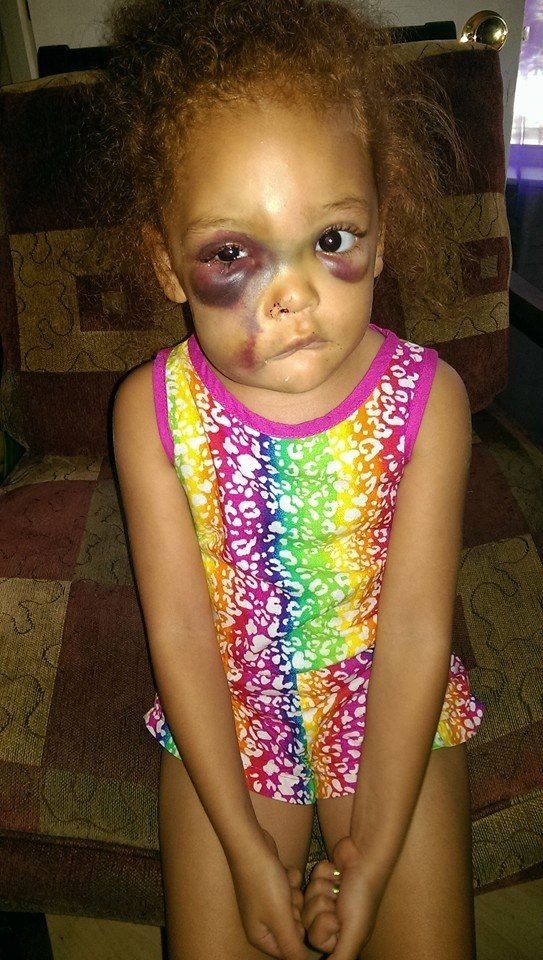 truyorkbity:  AvaLynn was attacked by another student on the school playground. We