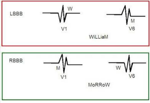 studentparamedics: “You can distinguish between Left Bundle Branch Block and Right Bundle Bran