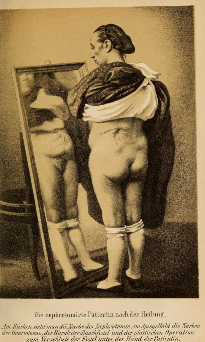 nemfrog:  Multiple surgeries. A patient looks in a mirror at scars from the removal