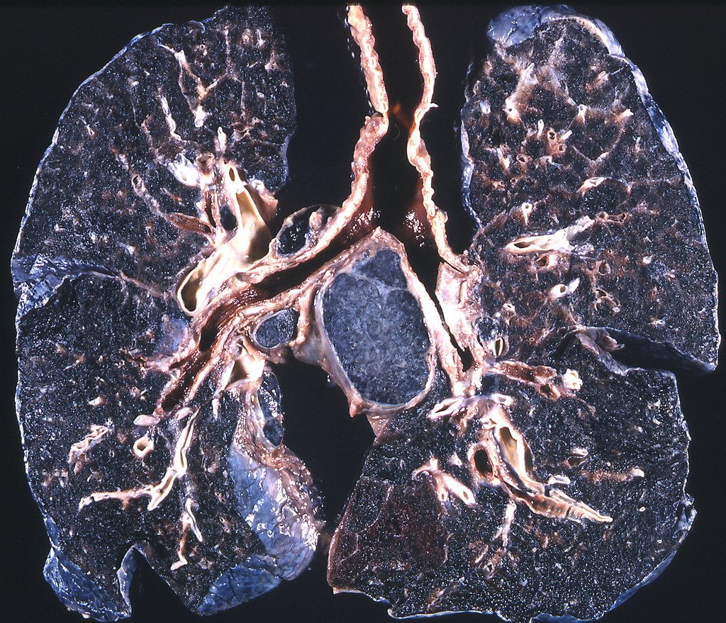 quadranopia:  Coal Worker’s Pneumoconiosis This lung disease is caused by the prolonged