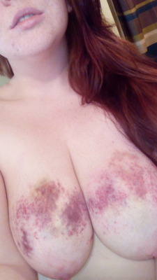 sadisticwhitedom:  I’m too big of a fan of my bruises right now to wait until tomorrow , oops .  Impressive. I hope you had fun.