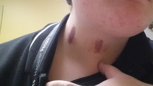 Selfie: My neck. Right now. Proof that lesbians have all the fun ;)PS. Give my girlfriend a round of