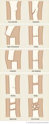 brains-and-bodies:  Different type of fractures“Buckle