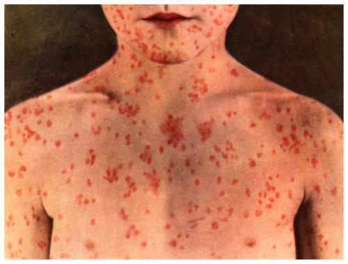 jayparkinsonmd: There’s currently a measles outbreak occurring in Williamsburg and Borough Par