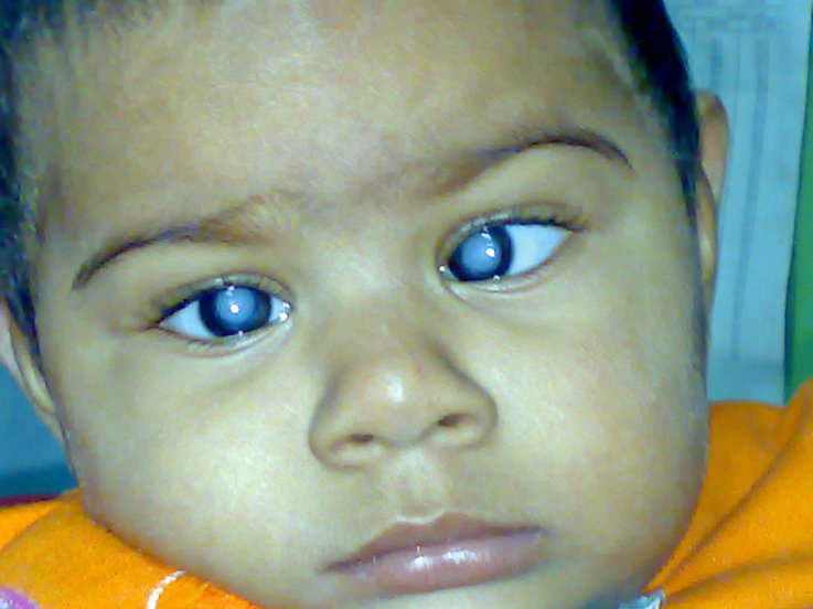 cluelessmedic:  Congenital Rubella Infection greatest risk to baby if rubella is