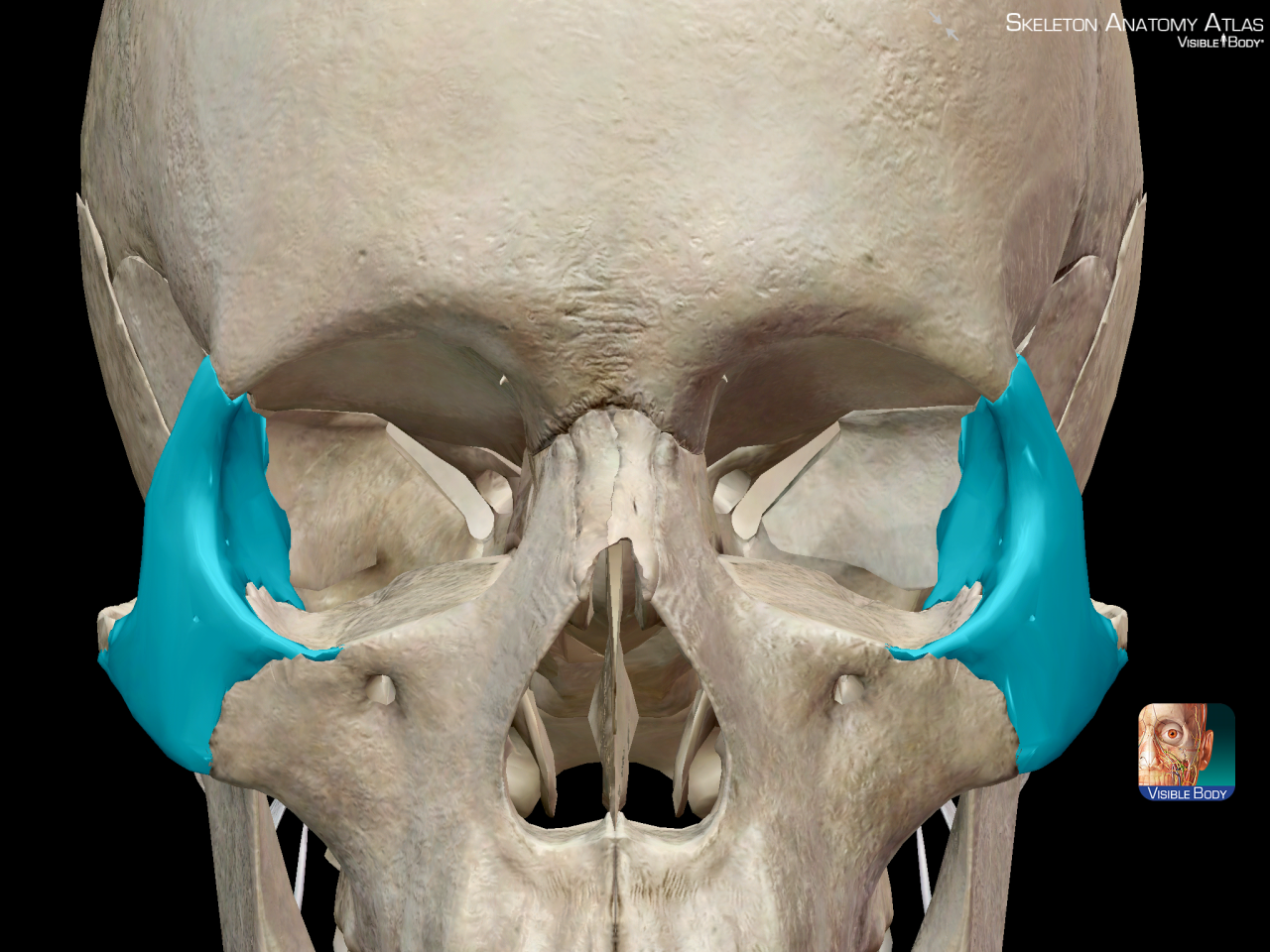 High cheekbones are caused by prominent zygomatic...