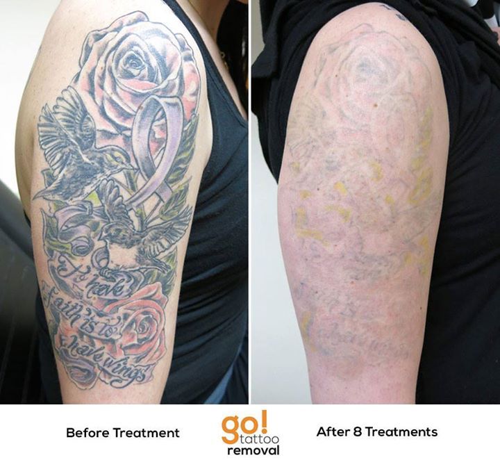 Laser Tattoo Removal Before and After Photos  Cosmetic Dermatology  Knoxville TN