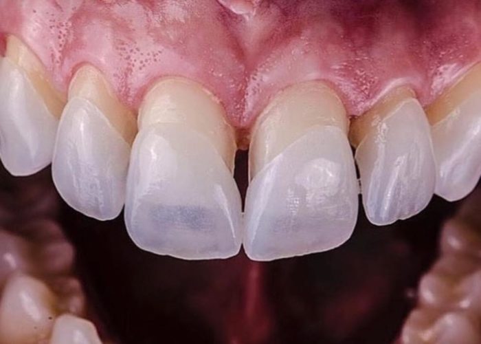 Porselen Dis Kaplama Nedir Nasil Yapilir Dent Dizayn Agiz Ve Dis Sagligi Klinigi Sancaktepe Dis Hastanesi Bagdat Caddesi