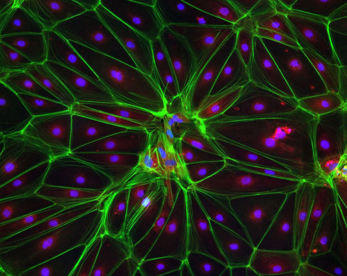 Huntington’s stem cell derived oligodendrocyte precursors stained for phalloidin (green), vinculin (red) and DNA (blue).