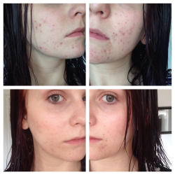 photo-witch:photo-witch:I’ve suffered from really awful cystic acne (the super painful kind) for my entire life, and I even went through a stint where a dermatologist put me on meds in order to kill the bacteria that causes acne. I’ve tried every