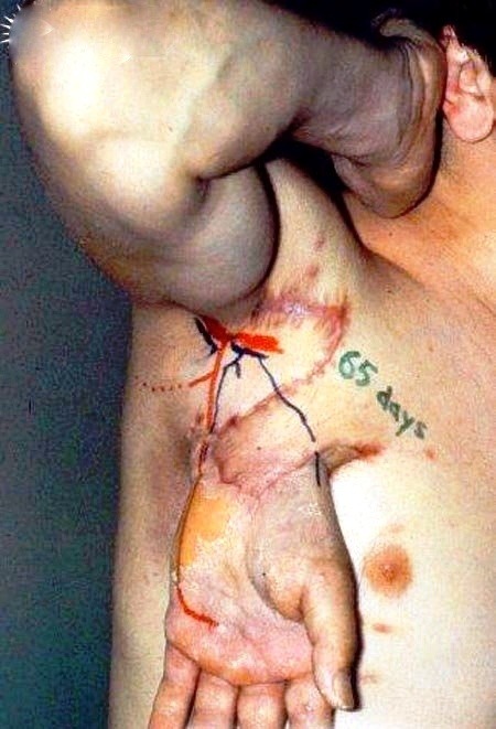 XXX Amputated hand re-attached to the patient’s photo