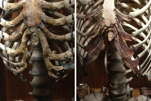 Porn From the MutterMuseum - the deformed ribcage photos