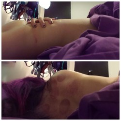 inked-m3rmaid:  My body after firecupping,