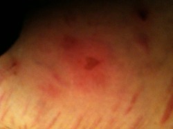 crazy-alone-forever:  One of my lighter burns is a heart shape,