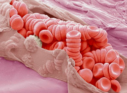 yeardleysmith:  Scanning electron microscopy (SEM) image of a ruptured venule