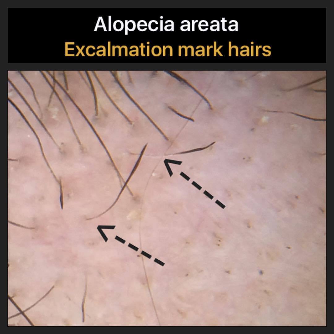 Blog of a Hair Loss Physician — “Exclamation mark hairs” in the autoimmune  hair...