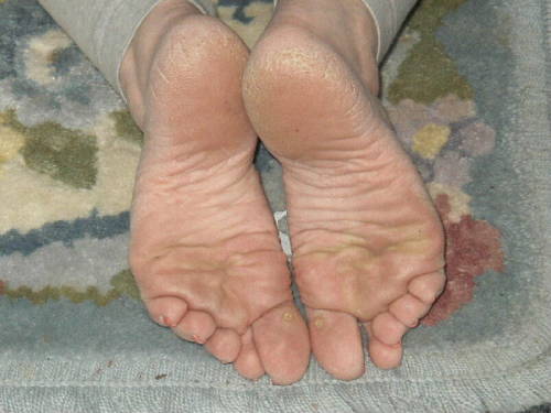 ROUGH SOLES