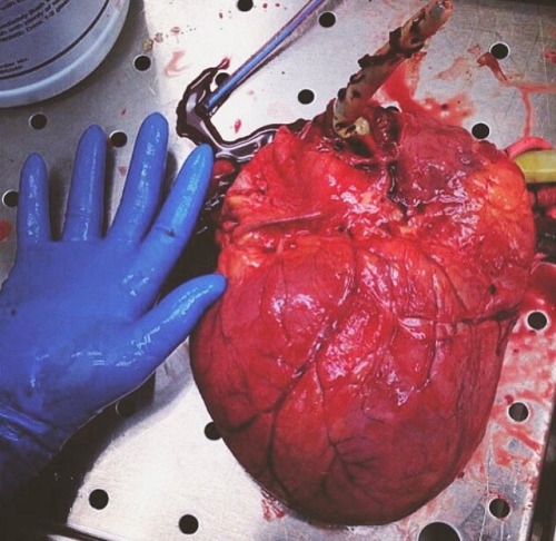 nursingthehudson: Enlarged Heart (Cardiomegaly) Belonged to 27 year old with Morbid Obesity, diabete
